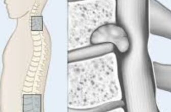 Top Neuro Spine Surgeon in India Leads Innovative Spine Tumor Therapies