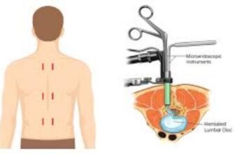 Recovery After Minimally Invasive Spine Surgery