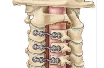 Best Cervical Spine Surgeon in India Explains the Benefits of Personalized Surgical Planning