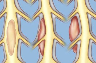 Early Signs of Spine Tumors You Shouldn’t Ignore