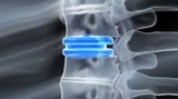 Advanced Cervical Spine Surgery & Disc Replacement Options in Kolkata
