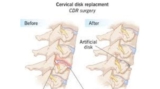 Disc Replacement in Kolkata – Consult the Best Cervical Spine Surgeon for Expert Care