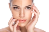 Hyperpigmentation Disorders Treatment Market Gain Prominence Over the Forecast Period Growing Rapidly
