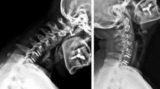 Motion Preserving Cervical Disc Replacement: A Modern Breakthrough in Spine Care