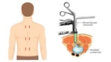 Recovery After Minimally Invasive Spine Surgery