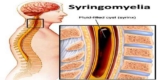 Syringomyelia Market Insights, Research Study and 2017 Briefing, Forecast till 2023