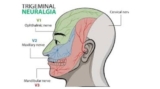 Trigeminal Neuralgia Treatment in Kolkata: A Proven Track Record of Success