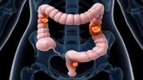 Colorectal Cancer Market by Major Key Companies, Diagnosis, Treatment, and Drug Delivery